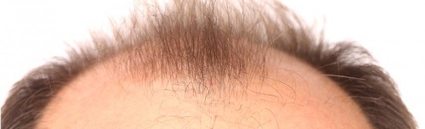 A radioterapia faz o cabelo cair?