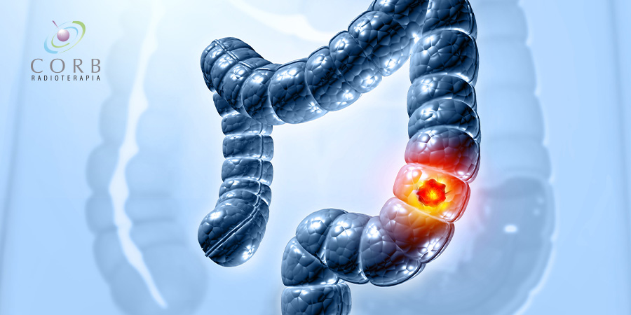Radioterapia no câncer colorretal: como e quando ela é utilizada?