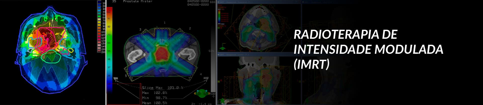 Radioterapia Com Intensidade Modulada Imrt Tratamentos Corb Radioterapia 1860